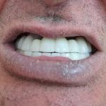 دندانسازی شرق | دندانسازی تهرانپارس | لابراتوار پروتزهای دندانی متحرک